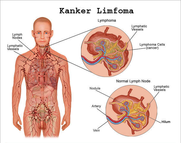 Mengenali Kanker Limfoma Yang Menyerang Olga